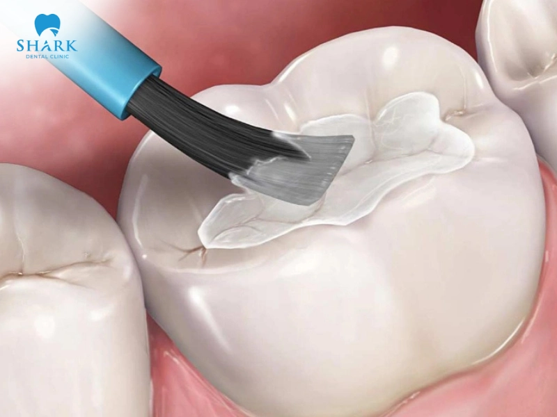 Kỹ thuật trám răng là nguyên nhân khiến miếng trám bị đen