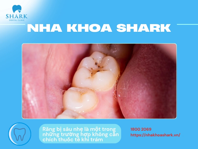 Răng bị sâu nhẹ, vi khuẩn chưa xâm nhập vào tủy là những trường hợp không cần chích thuốc tê khi trám răng