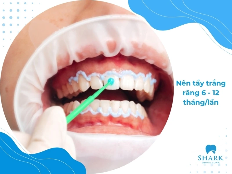 Thực hiện tẩy trắng răng định kỳ 6-12 tháng/lần