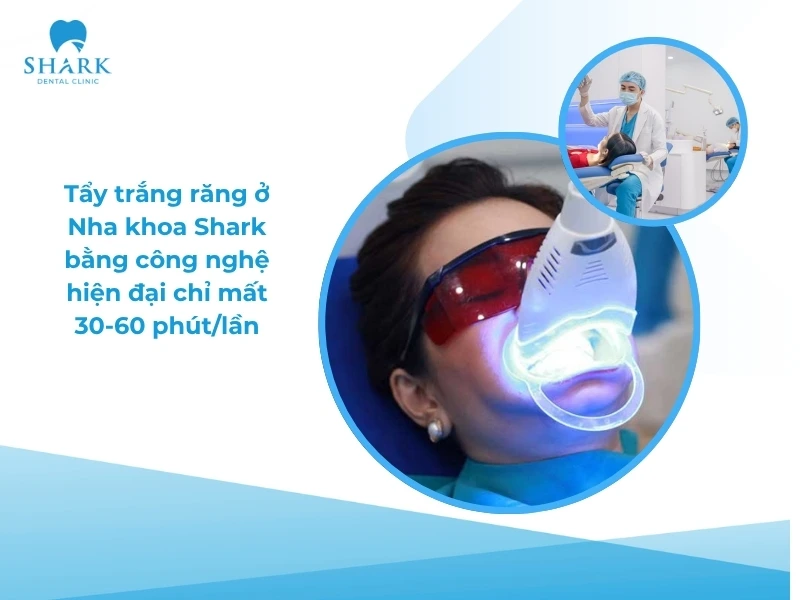 Tẩy trắng răng mất khoảng 1h đồng hồ