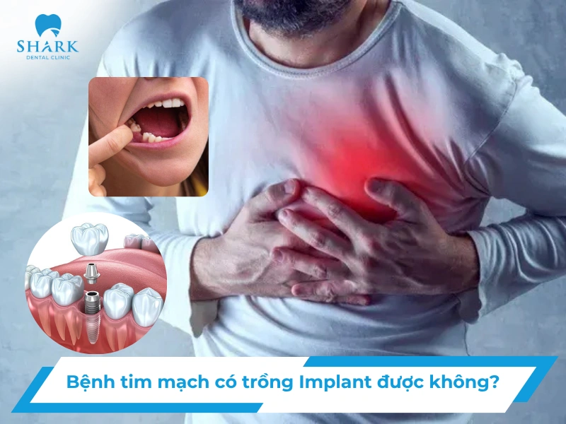 Bệnh tim mạch có trồng implant được không?