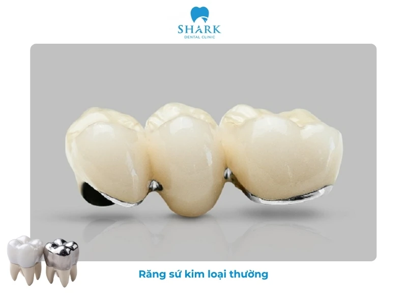 Răng sứ kim loại có giá 2 triệu