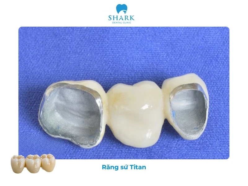 Răng sứ Titan có khoảng giá từ 2 triệu trở lên