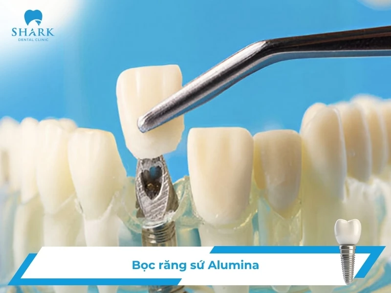 Răng sứ Alumina