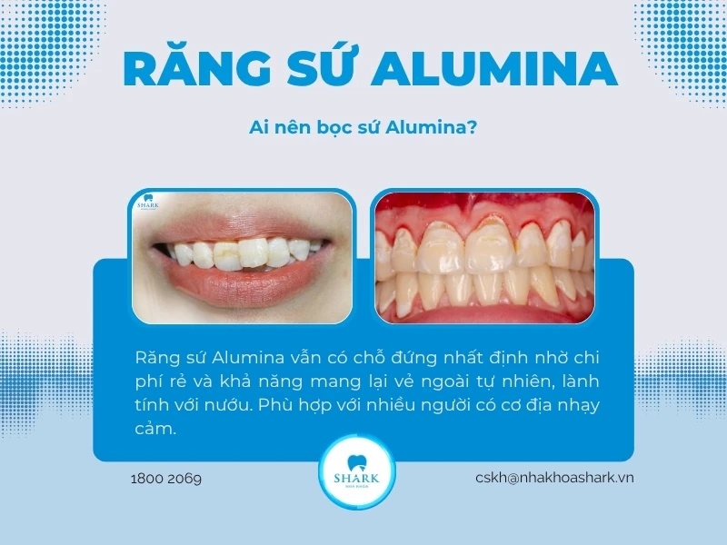 Phù hợp với người có răng cửa lệch và cần phải cải thiện thẩm mỹ răng miệng