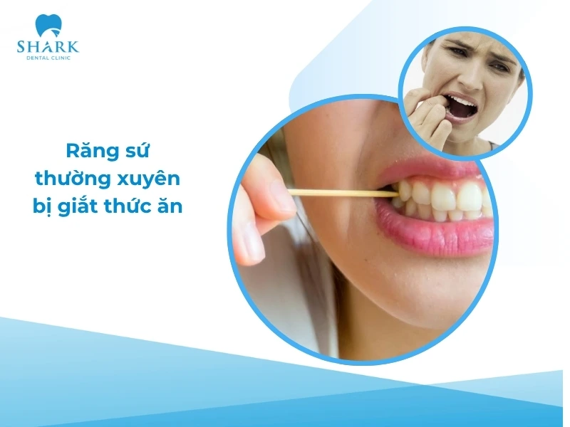 Răng sứ bị giắt thức ăn