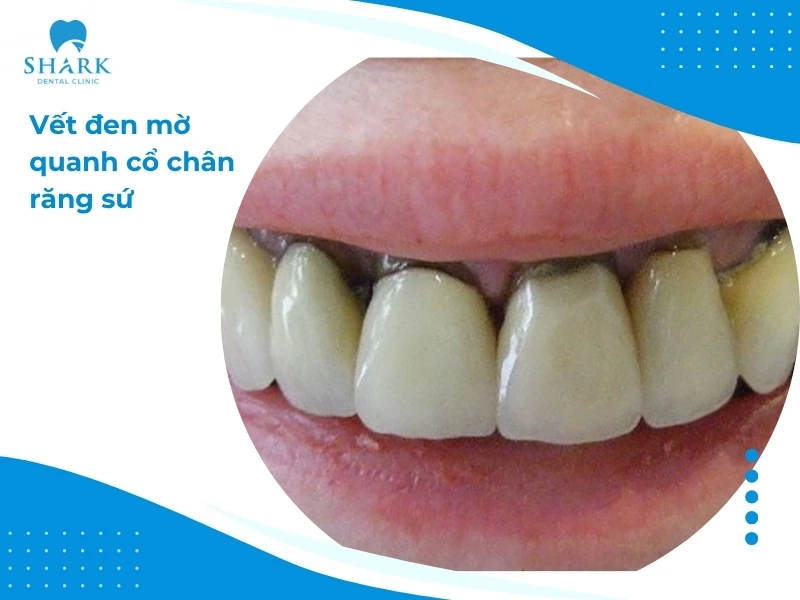 Cổ chân răng sứ bị đen