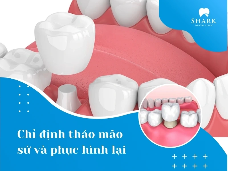 Tháo và lắp lại mão sứ mới