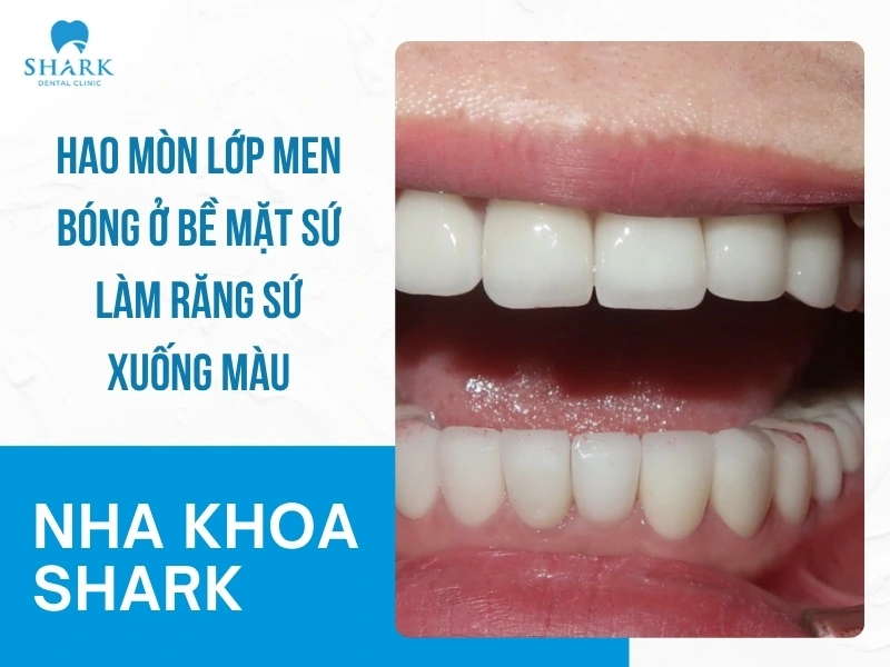 Lớp men sứ bị hao mòn dẫn đến lộ ngà răng thật