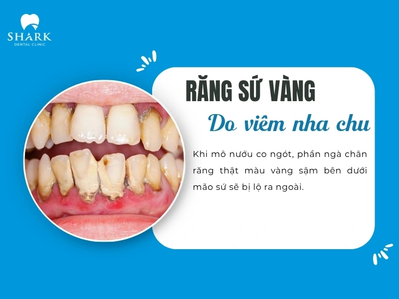 Viêm nha chu làm răng xuống màu do tuột nướu lộ chân răng thật và các biến chứng khác