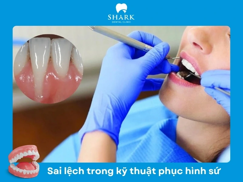 Sai lệch trong kỹ thuật phục hình răng sứ