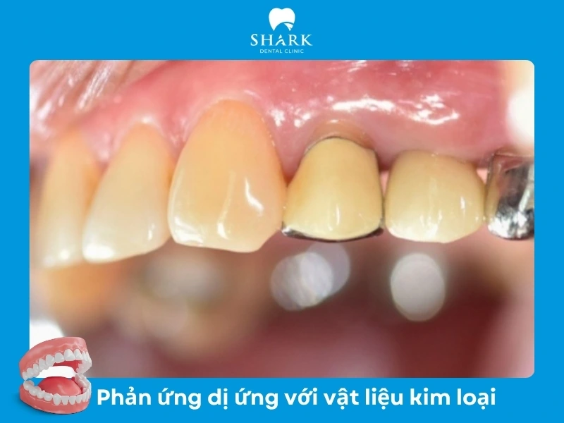 Sử dụng răng sứ kim loại lâu ngày bị phản ứng với kim loại