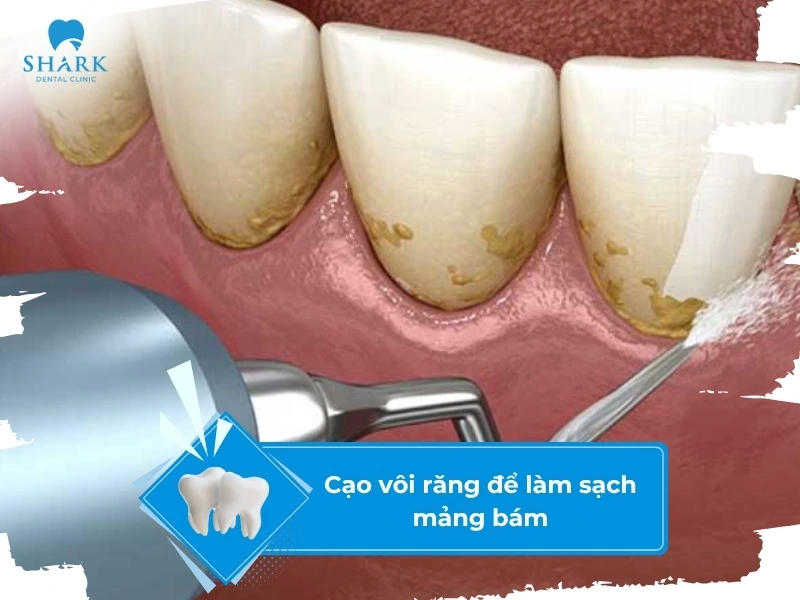 Cạo vôi răng định kỳ