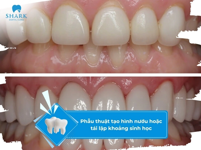 Phẫu thuật tạo hình lại nướu