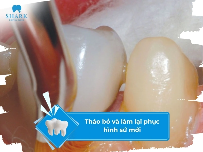 Tháo bỏ mão sứ cũ