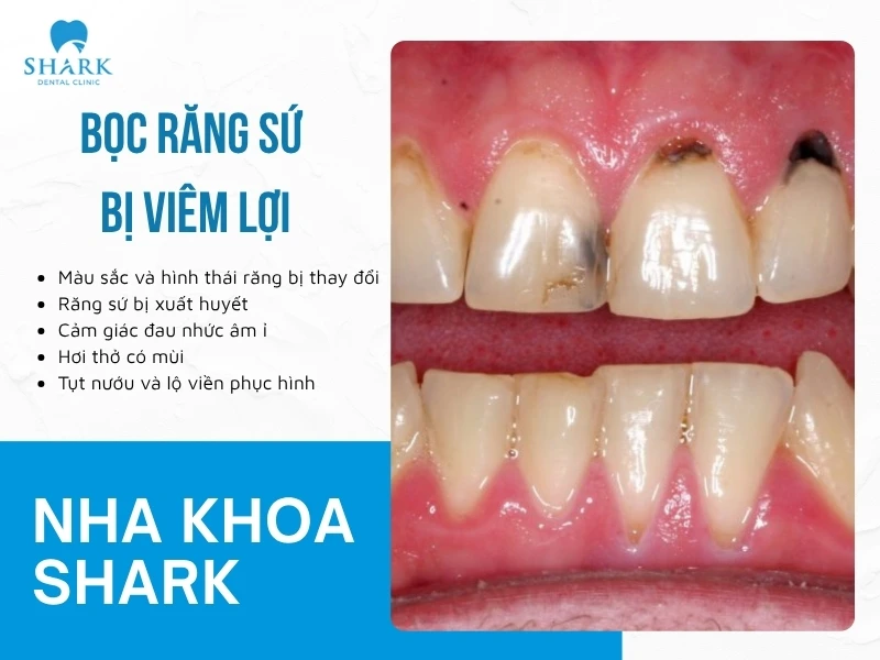 Bọc răng sứ bị viêm lợi