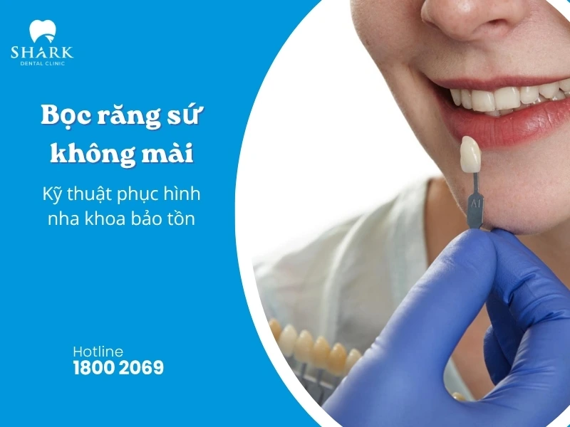 Bọc sứ không mài