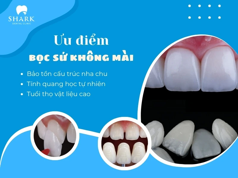 Bảo tồn cấu trúc răng thật là ưu điểm hàng đầu của kỹ thuật bọc sứ không mài