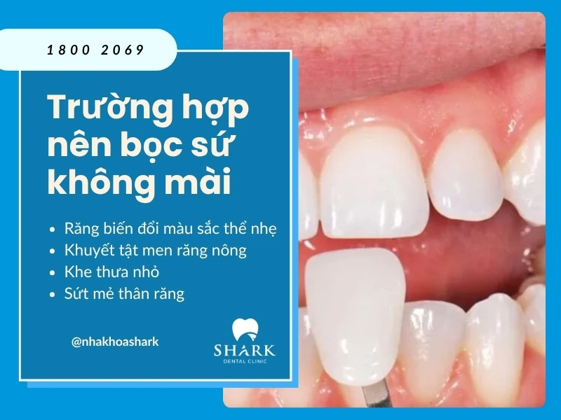 Răng bị khuyết điểm nhẹ là đối tượng phù hợp để bọc sứ không mài