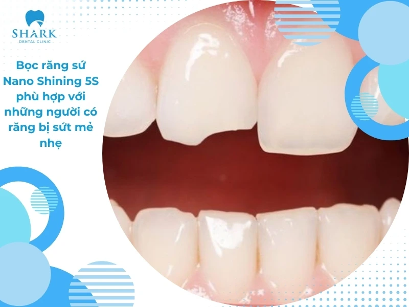 Bọc răng sứ Nano Shining 5S là gì? Loại sứ này có tốt không? 12 Phù hợp với những người có răng bị sứt mẻ nhẹ