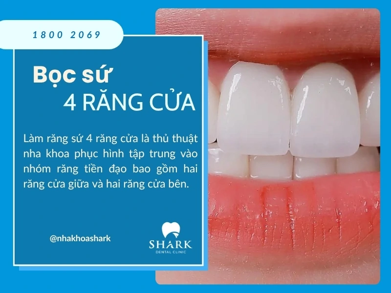 Bọc sứ răng cửa là kỹ thuật phục hình đòi hỏi tay nghề bác sĩ giỏi