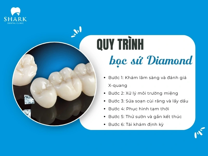 Quy trình bọc sứ chuẩn gồm 6 bước an toàn