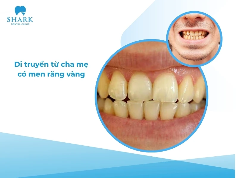 10 Mẹo làm trắng răng trong 5 phút tại nhà hiệu quả và an toàn 19 Di truyền từ cha mẹ đã có răng vàng thì con cái sẽ dễ bị vàng răng