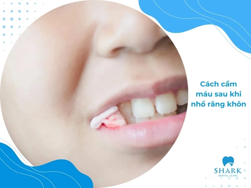 Mẹo cầm máu sau khi nhổ răng khôn đúng cách và an toàn 9 Cầm máu khi nhổ răng khôn