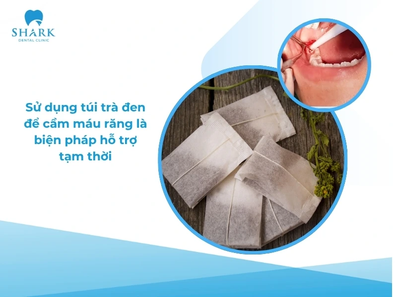 Mẹo cầm máu sau khi nhổ răng khôn đúng cách và an toàn 11 Sử dụng túi trà đen để cầm máu sau nhổ răng chỉ là biện pháp tạm thời