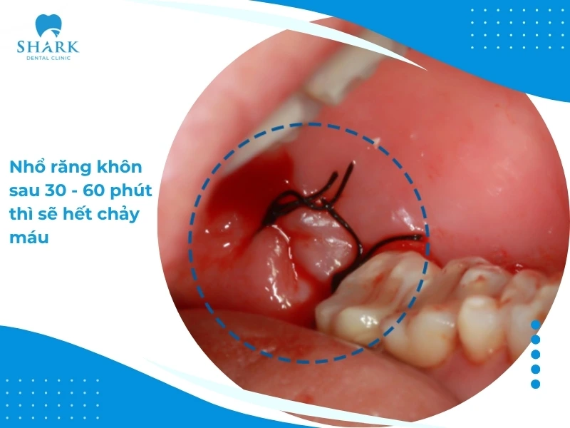 Mẹo cầm máu sau khi nhổ răng khôn đúng cách và an toàn 12 Nhổ răng khôn với tình trạng 1 chân răng thì thời gian cầm máu sẽ từ 30-60 phút