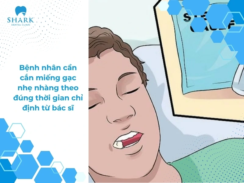 Mẹo cầm máu sau khi nhổ răng khôn đúng cách và an toàn 10 Cắn gạc cầm máu nhẹ nhàng theo chỉ định từ nha sĩ