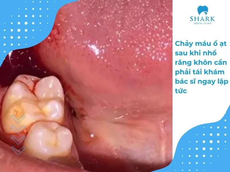 Mẹo cầm máu sau khi nhổ răng khôn đúng cách và an toàn 14 Máu chảy liên tục sau khi nhổ răng cần đi đến bác sĩ để thăm khám ngay