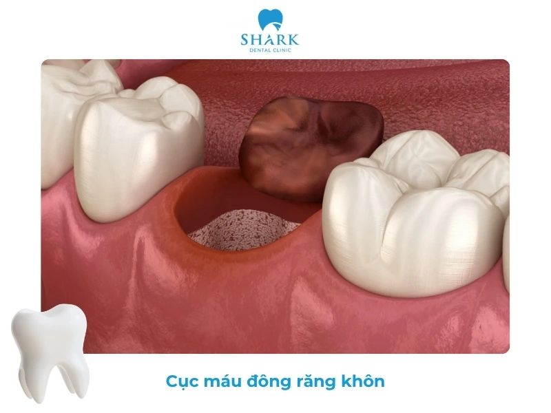 Mẹo cầm máu sau khi nhổ răng khôn đúng cách và an toàn 15 Cục máu đông rất quan trọng trong quá trình cầm máu sau nhổ răng