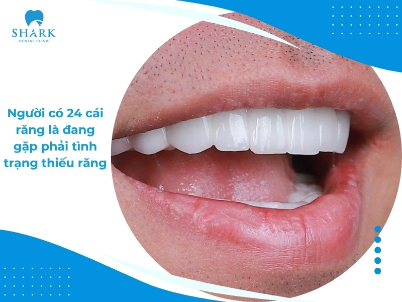 Con người có bao nhiêu cái răng? Có 24, 29, 36 răng thì sao? 12 Người có 24 cái răng là đang bị thiếu răng