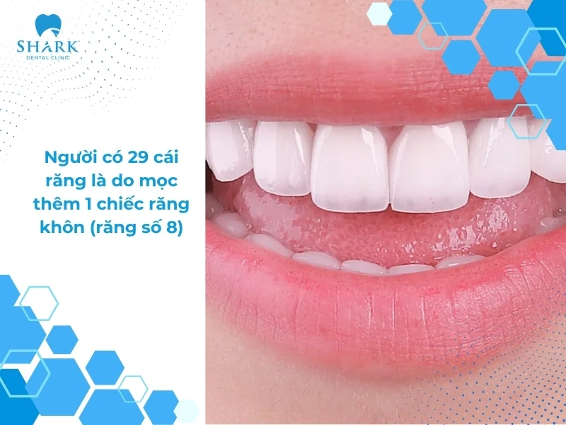 Con người có bao nhiêu cái răng? Có 24, 29, 36 răng thì sao? 13 Người 29 cái răng là có thêm 1 răng khôn