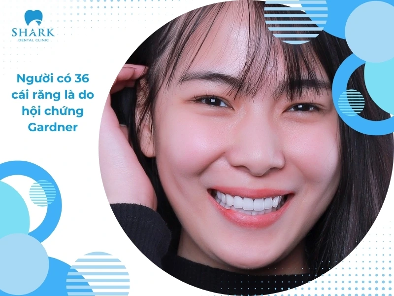 Con người có bao nhiêu cái răng? Có 24, 29, 36 răng thì sao? 14 36 cái răng ở một người là đang gặp phải tình trạng răng mọc thừa