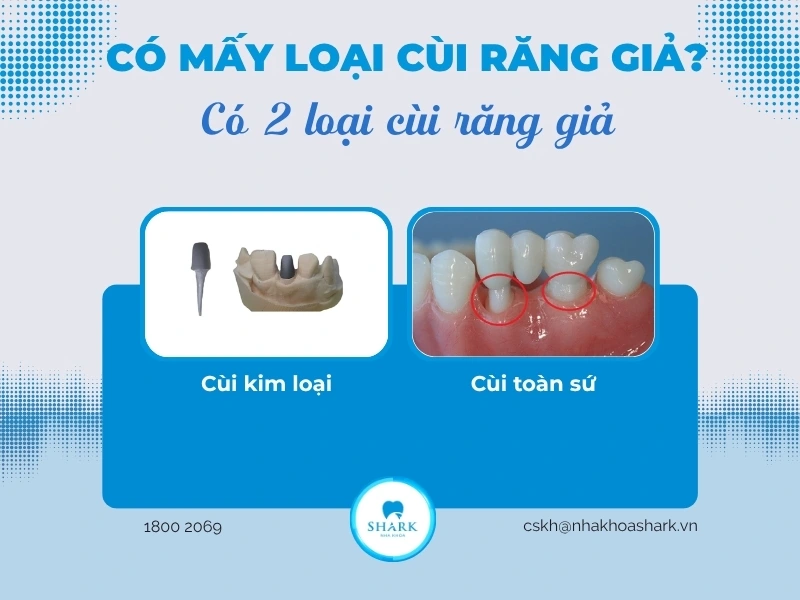Có 2 loại cùi răng giả: cùi kim loại và cùi toàn sứ