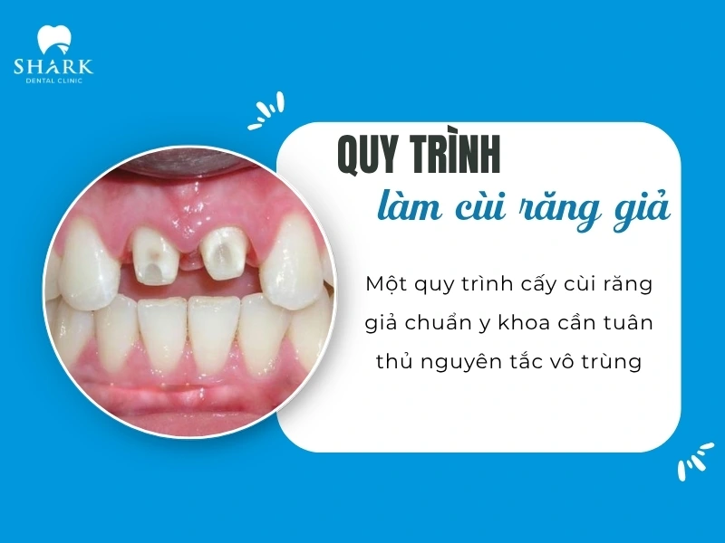Quy trình làm cùi răng giả chuẩn y khoa