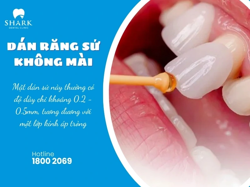 Dán răng sứ không mài