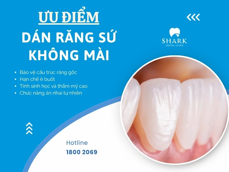 Dán sứ Veneer không mài răng mang lại nhiều lợi ích cho cấu trúc răng thật