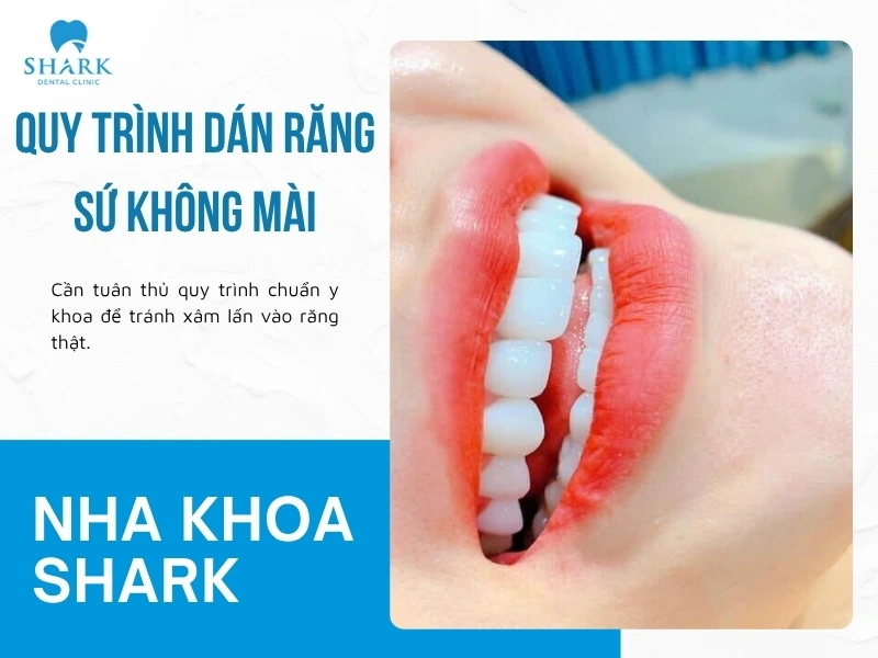 Quy trình dán sứ không cần mài răng
