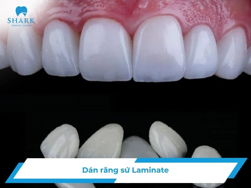 Dán sứ Laminate