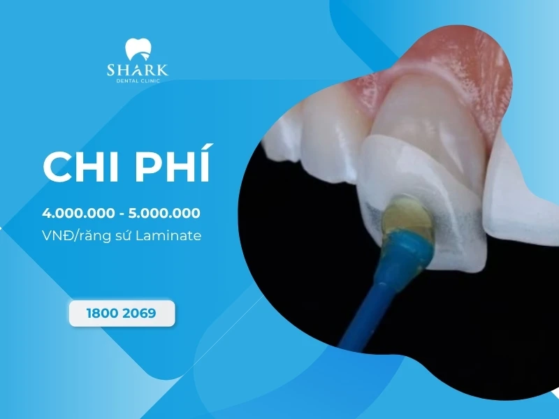 Dán răng sứ Laminate là gì? Giá dán Laminate bao nhiêu tiền? 13 Mức giá tham khảo cho dán sứ Laminate là 4.000.000 - 5.000.000 VNĐ/răng