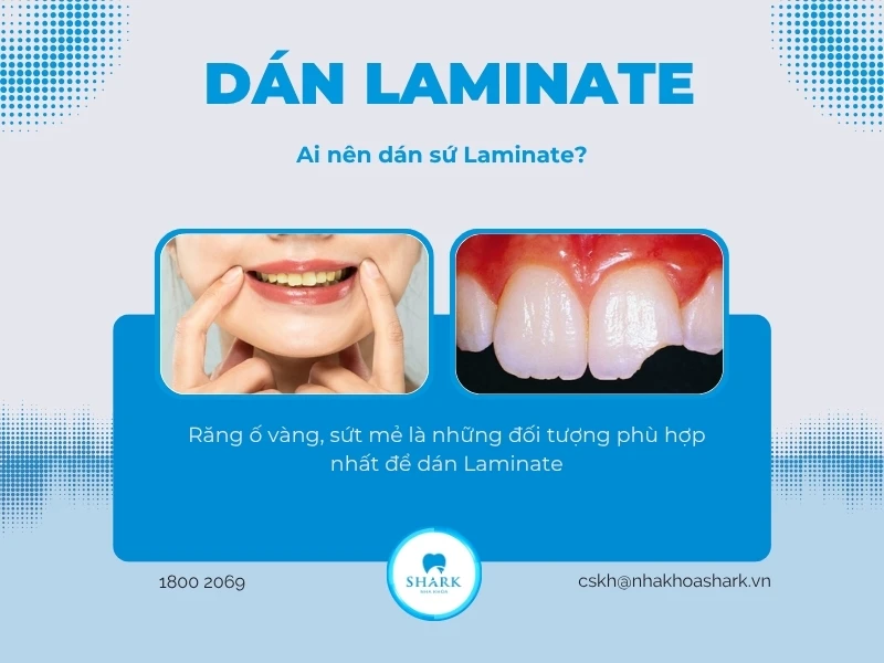 Dán răng sứ Laminate là gì? Giá dán Laminate bao nhiêu tiền? 12 Khách hàng gặp tình trạng răng bị ố vàng hay xỉn màu có thể ưu tiên lựa chọn phương pháp này để làm trắng răng