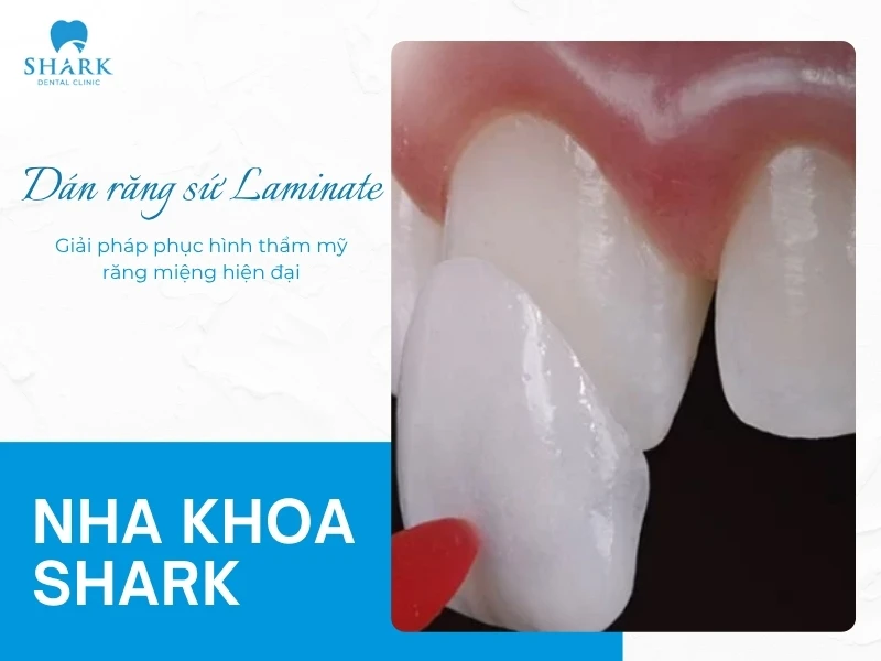 Dán răng sứ Laminate là gì? Giá dán Laminate bao nhiêu tiền? 9 Dán răng sứ Laminate - giải pháp phục hình thẩm mỹ răng miệng hiện đại