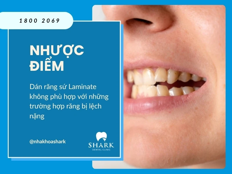 Dán răng sứ Laminate là gì? Giá dán Laminate bao nhiêu tiền? 11 Dán răng sứ Laminate không phù hợp với những trường hợp răng bị lệch nặng