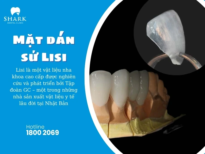 Mặt dán sứ Lisi có xuất xứ từ Nhật Bản
