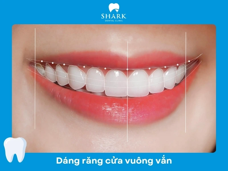 Dáng răng cửa vuông vắn