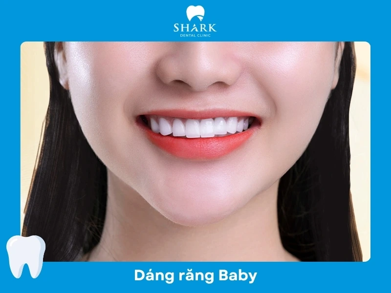 Dáng răng sứ Baby