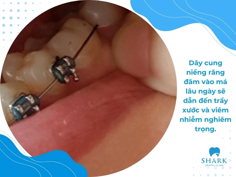 Dây cung đâm vào má lâu ngày sẽ dẫn đến các biến chứng không tốt cho sức khỏe răng miệng